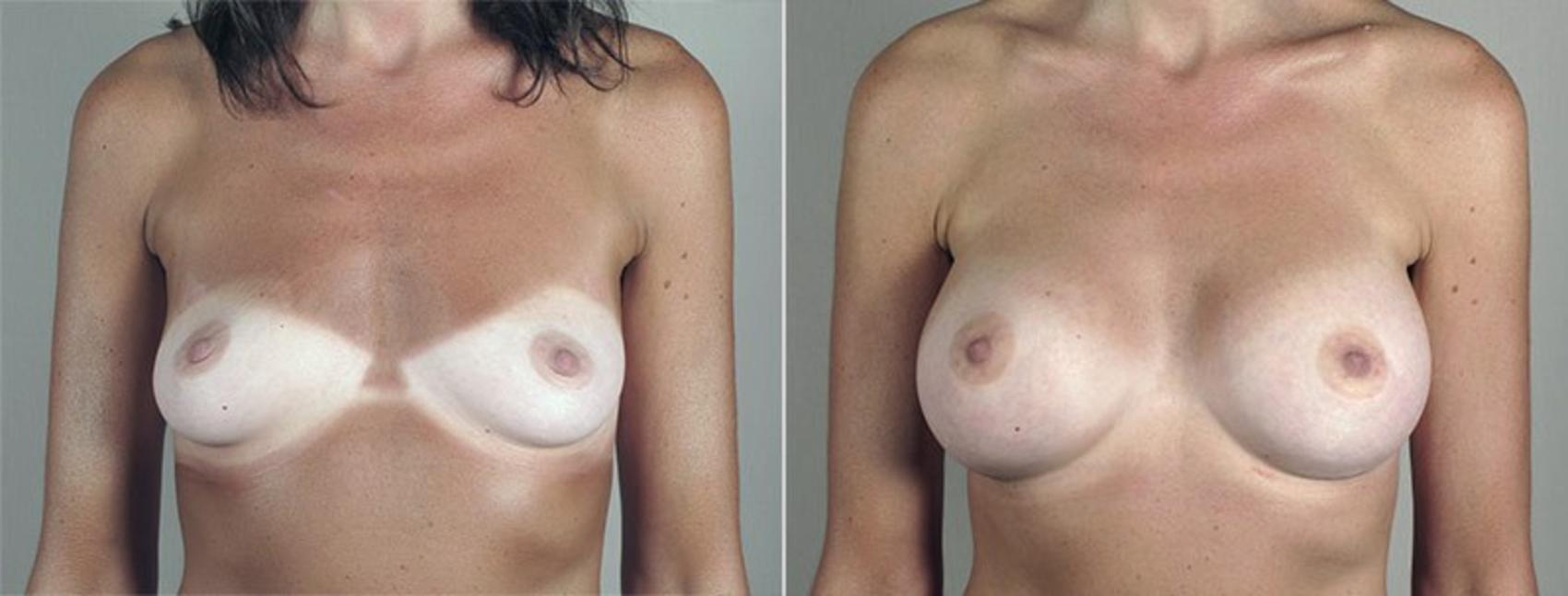 Breast Augmentation Case 435 Before & After View #1 | Paramus, New Jersey | Parker Center for Plastic Surgery