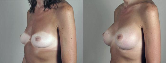 Breast Augmentation Case 435 Before & After View #2 | Paramus, New Jersey | Parker Center for Plastic Surgery