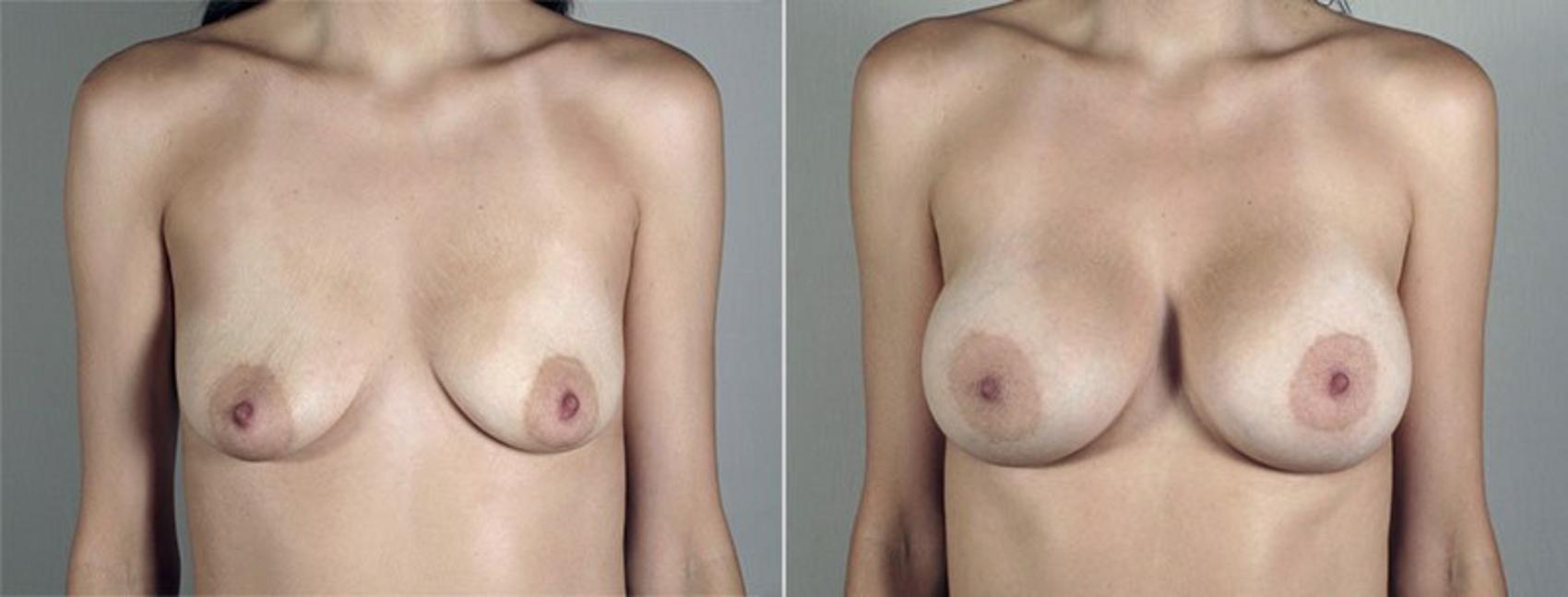 Breast Augmentation Case 436 Before & After View #1 | Paramus, New Jersey | Parker Center for Plastic Surgery