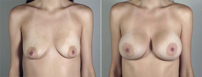 Breast Augmentation Case 436 Before & After View #1 | Paramus, New Jersey | Parker Center for Plastic Surgery