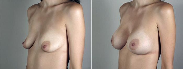 Breast Augmentation Case 436 Before & After View #2 | Paramus, New Jersey | Parker Center for Plastic Surgery