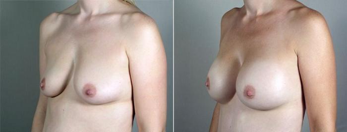 Breast Augmentation Case 438 Before & After View #2 | Paramus, New Jersey | Parker Center for Plastic Surgery