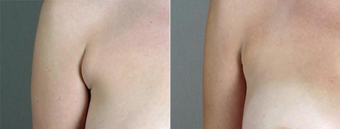 Breast Augmentation Case 438 Before & After View #3 | Paramus, New Jersey | Parker Center for Plastic Surgery