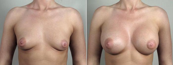 Breast Augmentation Case 439 Before & After View #1 | Paramus, New Jersey | Parker Center for Plastic Surgery