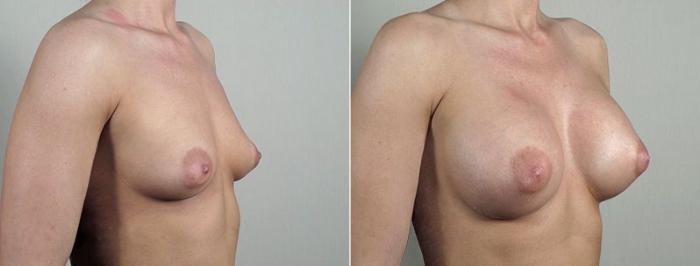 Breast Augmentation Case 439 Before & After View #2 | Paramus, New Jersey | Parker Center for Plastic Surgery