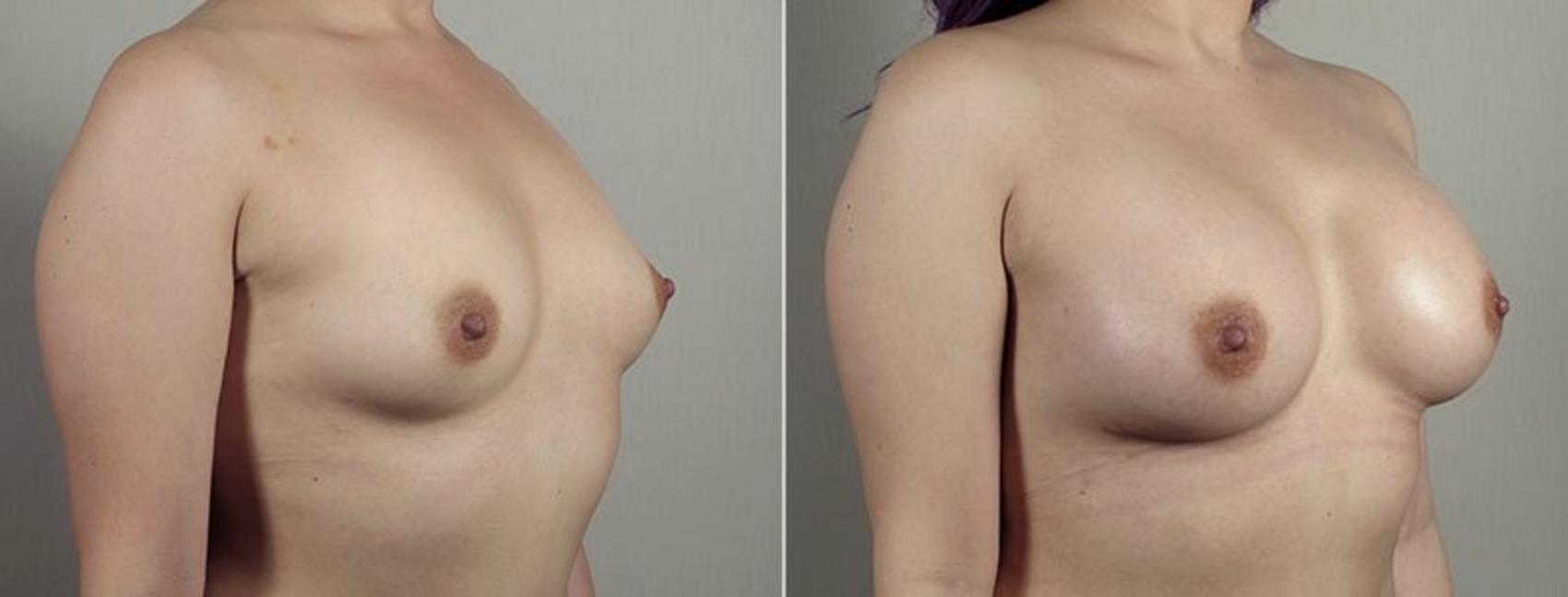 Breast Augmentation Case 441 Before & After View #1 | Paramus, New Jersey | Parker Center for Plastic Surgery