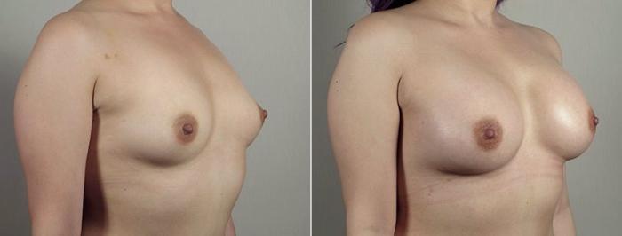 Breast Augmentation Case 441 Before & After View #1 | Paramus, New Jersey | Parker Center for Plastic Surgery