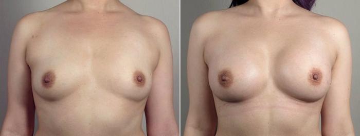 Breast Augmentation Case 441 Before & After View #2 | Paramus, New Jersey | Parker Center for Plastic Surgery