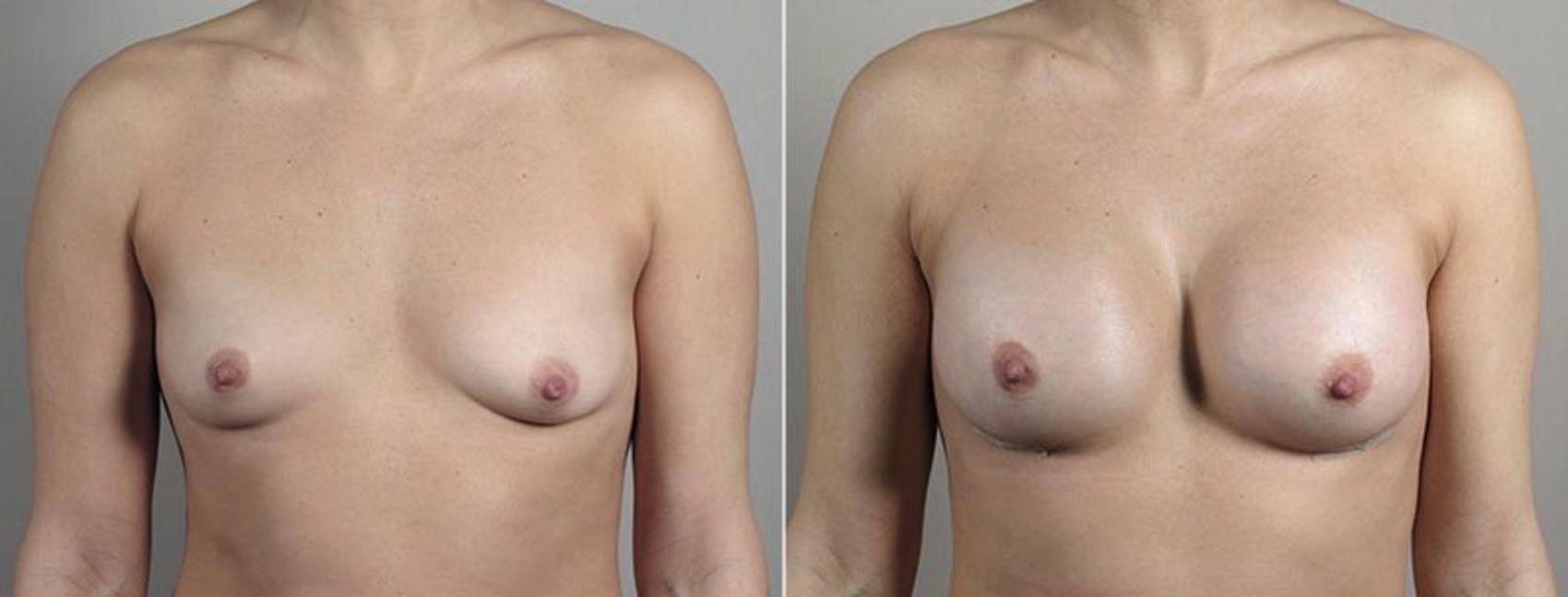 Breast Augmentation Case 442 Before & After View #1 | Paramus, New Jersey | Parker Center for Plastic Surgery