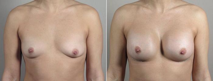 Breast Augmentation Case 442 Before & After View #1 | Paramus, New Jersey | Parker Center for Plastic Surgery
