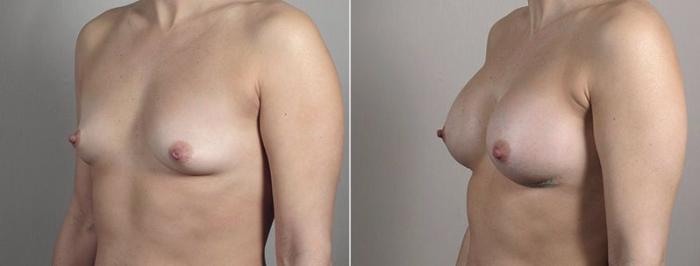 Breast Augmentation Case 442 Before & After View #2 | Paramus, New Jersey | Parker Center for Plastic Surgery