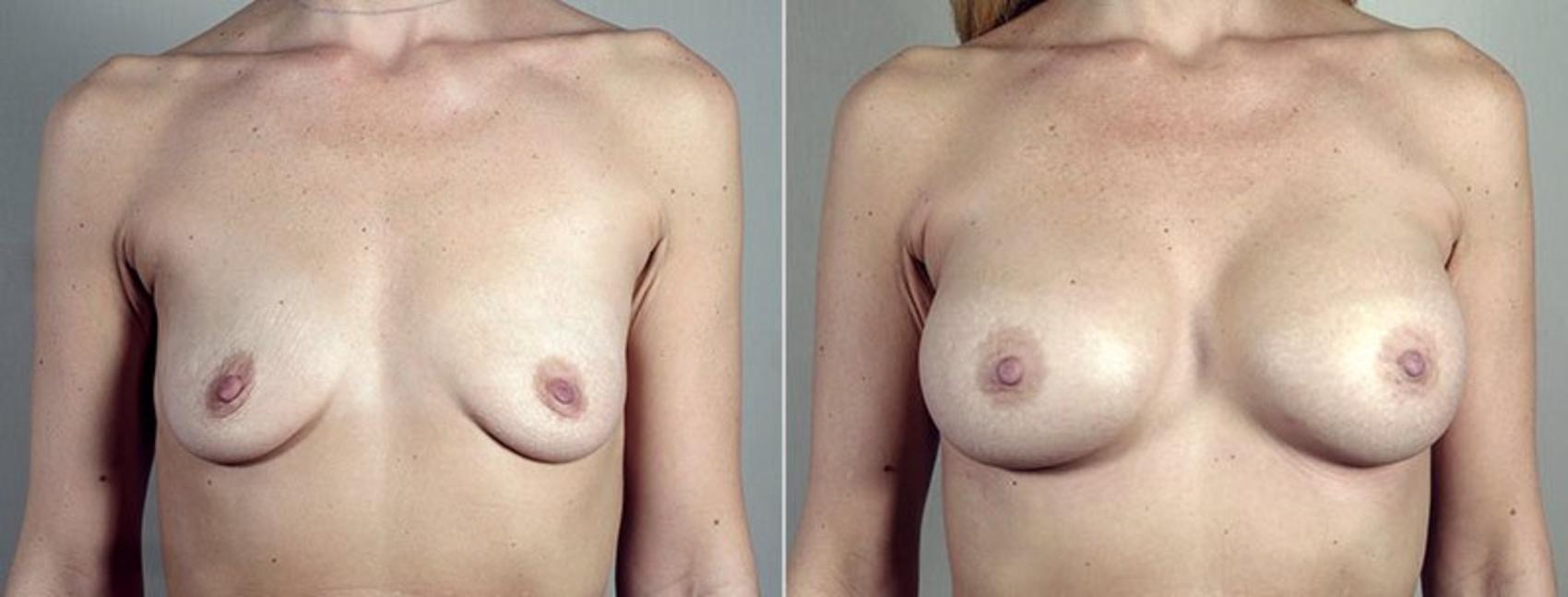 Breast Augmentation Case 444 Before & After View #1 | Paramus, New Jersey | Parker Center for Plastic Surgery