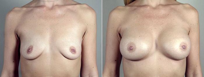 Breast Augmentation Case 444 Before & After View #1 | Paramus, New Jersey | Parker Center for Plastic Surgery