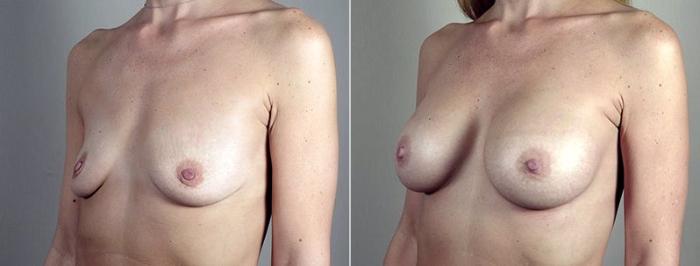 Breast Augmentation Case 444 Before & After View #2 | Paramus, New Jersey | Parker Center for Plastic Surgery