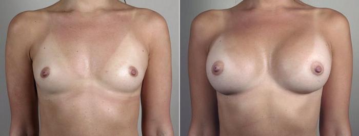 Breast Augmentation Case 445 Before & After View #1 | Paramus, New Jersey | Parker Center for Plastic Surgery