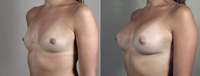 Breast Augmentation Case 445 Before & After View #2 | Paramus, New Jersey | Parker Center for Plastic Surgery