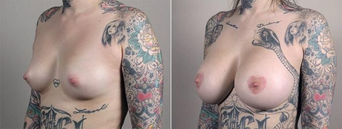 Breast Augmentation Case 446 Before & After View #2 | Paramus, New Jersey | Parker Center for Plastic Surgery