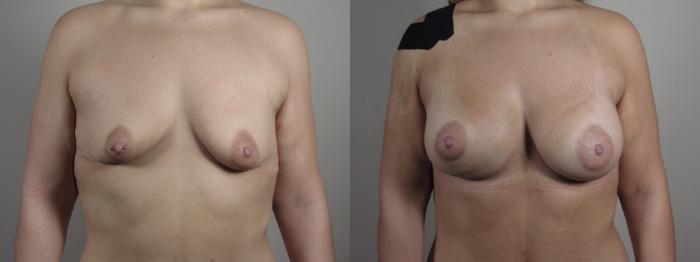 Breast Augmentation Case 992 Before & After Front breast | Paramus, New Jersey | Parker Center for Plastic Surgery