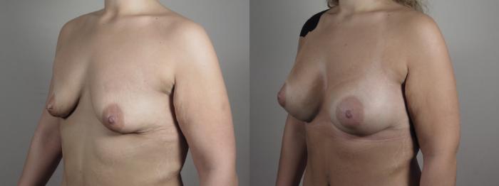 Breast Augmentation Case 992 Before & After Right Oblique | Paramus, New Jersey | Parker Center for Plastic Surgery
