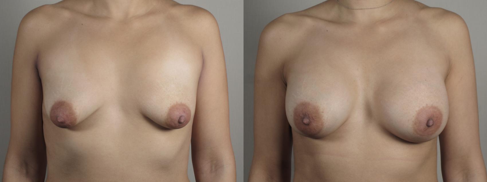 Breast Augmentation Case 994 Before & After Front | Paramus, New Jersey | Parker Center for Plastic Surgery