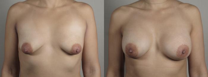 Breast Augmentation Case 994 Before & After Front | Paramus, New Jersey | Parker Center for Plastic Surgery