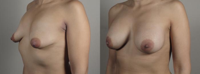 Breast Augmentation Case 994 Before & After Right Oblique | Paramus, New Jersey | Parker Center for Plastic Surgery