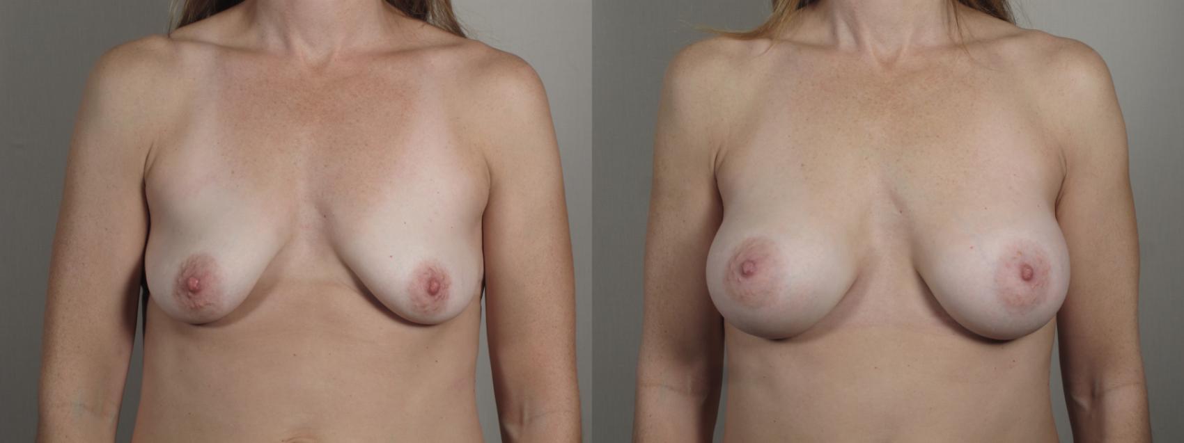 Breast Augmentation Case 995 Before & After Front | Paramus, New Jersey | Parker Center for Plastic Surgery