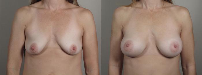 Breast Augmentation Case 995 Before & After Front | Paramus, New Jersey | Parker Center for Plastic Surgery