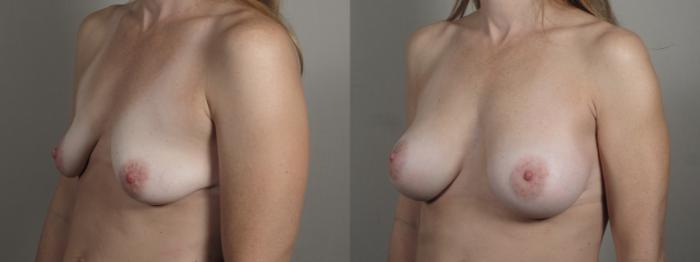 Breast Augmentation Case 995 Before & After Right Oblique | Paramus, New Jersey | Parker Center for Plastic Surgery
