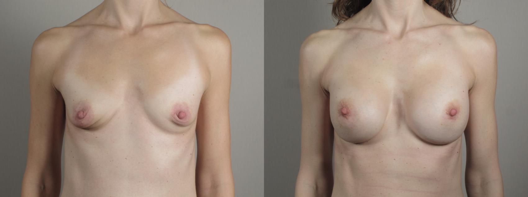 Breast Augmentation Case 996 Before & After Front | Paramus, New Jersey | Parker Center for Plastic Surgery
