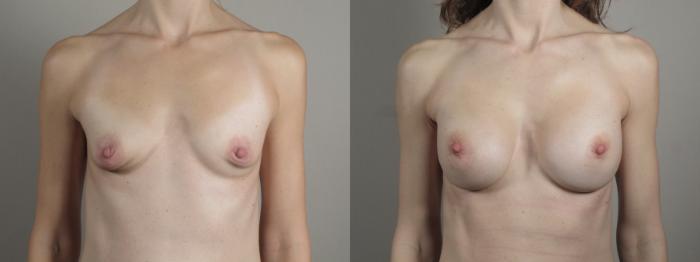 Breast Augmentation Case 996 Before & After Front | Paramus, New Jersey | Parker Center for Plastic Surgery