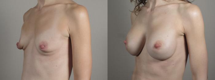 Breast Augmentation Case 996 Before & After Right Oblique | Paramus, New Jersey | Parker Center for Plastic Surgery