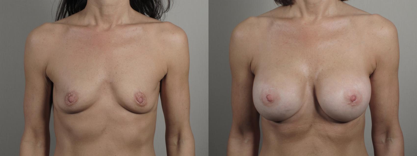 Breast Augmentation Case 997 Before & After Front | Paramus, New Jersey | Parker Center for Plastic Surgery