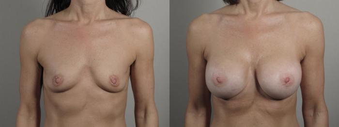 Breast Augmentation Case 997 Before & After Front | Paramus, New Jersey | Parker Center for Plastic Surgery
