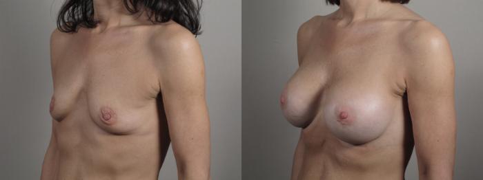 Breast Augmentation Case 997 Before & After Right Oblique | Paramus, New Jersey | Parker Center for Plastic Surgery