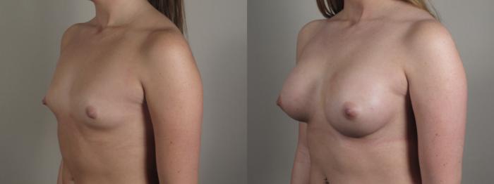 Breast Augmentation Case 998 Before & After Right Oblique | Paramus, New Jersey | Parker Center for Plastic Surgery