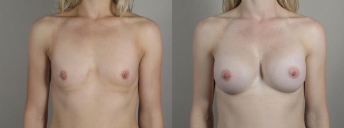Breast Augmentation Case 999 Before & After Front | Paramus, New Jersey | Parker Center for Plastic Surgery