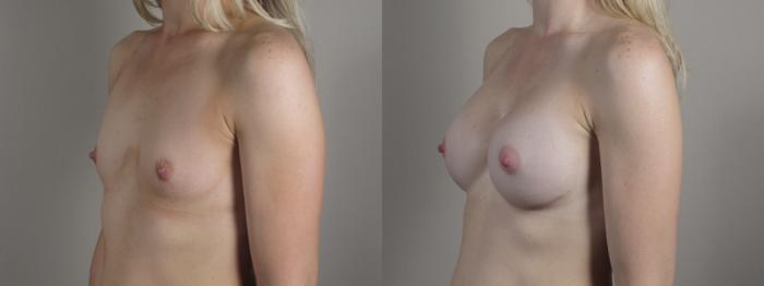 Breast Augmentation Case 999 Before & After Right Oblique | Paramus, New Jersey | Parker Center for Plastic Surgery