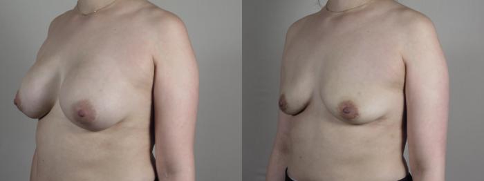 Breast Implant Removal Case 1026 Before & After Right Oblique | Paramus, New Jersey | Parker Center for Plastic Surgery