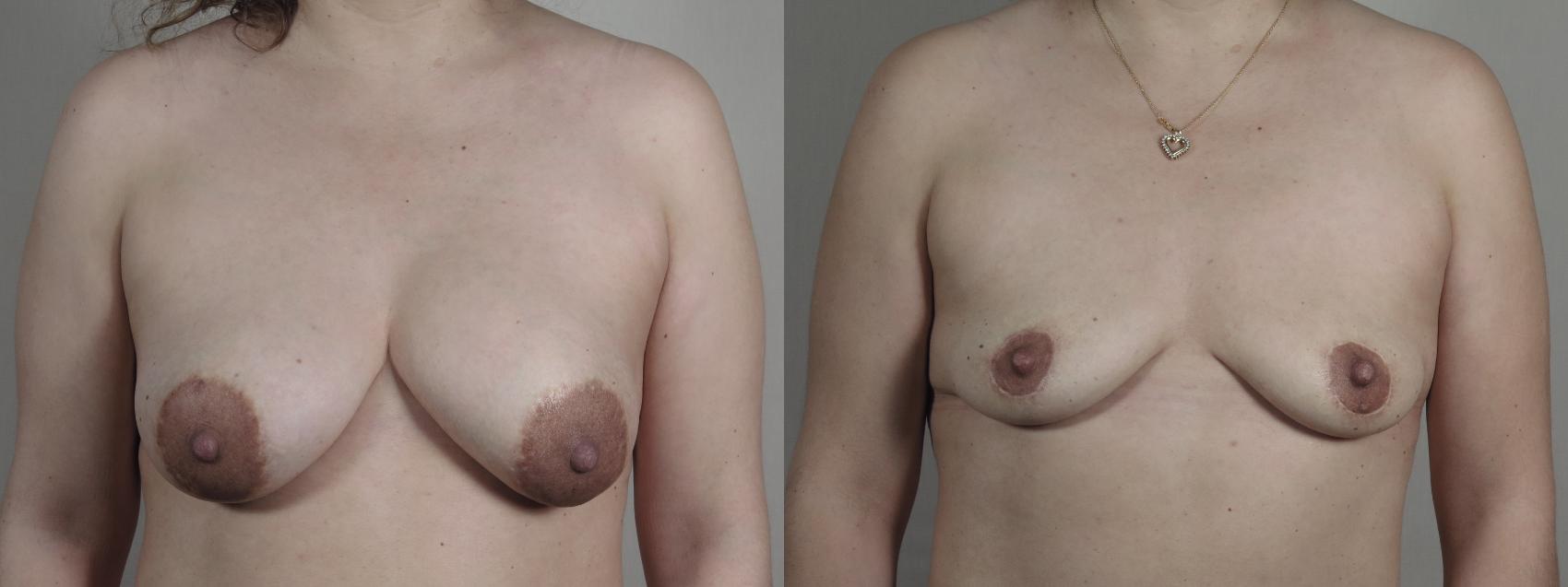 Breast Implant Removal Case 1195 Before & After View #1  | Paramus, New Jersey | Parker Center for Plastic Surgery