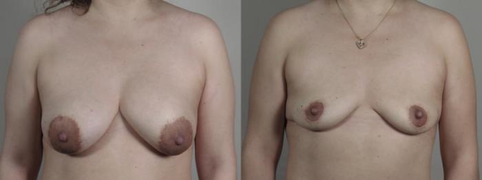 Breast Implant Removal Case 1195 Before & After View #1  | Paramus, New Jersey | Parker Center for Plastic Surgery