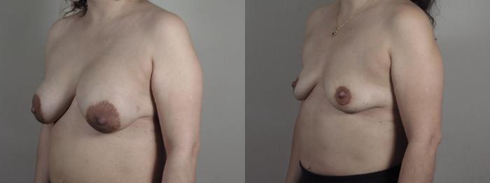 Breast Implant Removal Case 1195 Before & After View #2 | Paramus, New Jersey | Parker Center for Plastic Surgery