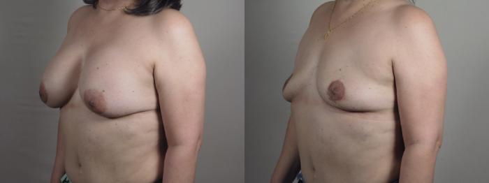 Breast Implant Removal Case 1196 Before & After View #2 | Paramus, New Jersey | Parker Center for Plastic Surgery