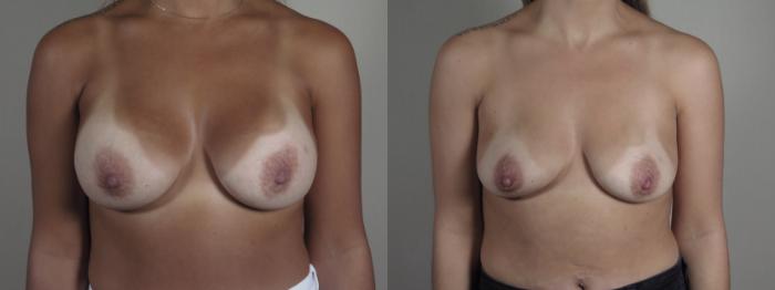 Breast Implant Removal Case 1197 Before & After View #1  | Paramus, New Jersey | Parker Center for Plastic Surgery