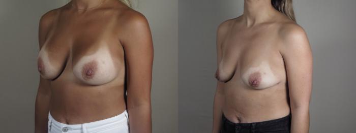 Breast Implant Removal Case 1197 Before & After View #2 | Paramus, New Jersey | Parker Center for Plastic Surgery