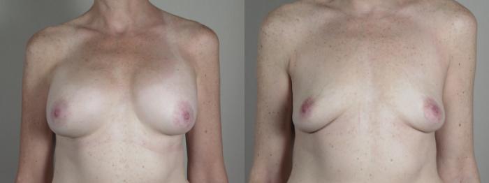 Breast Implant Removal Case 1216 Before & After View #1  | Paramus, New Jersey | Parker Center for Plastic Surgery