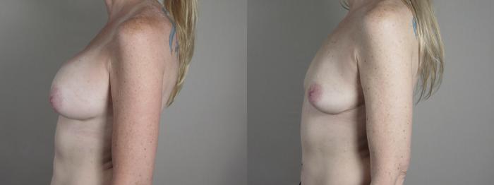 Breast Implant Removal Case 1216 Before & After View #2 | Paramus, New Jersey | Parker Center for Plastic Surgery