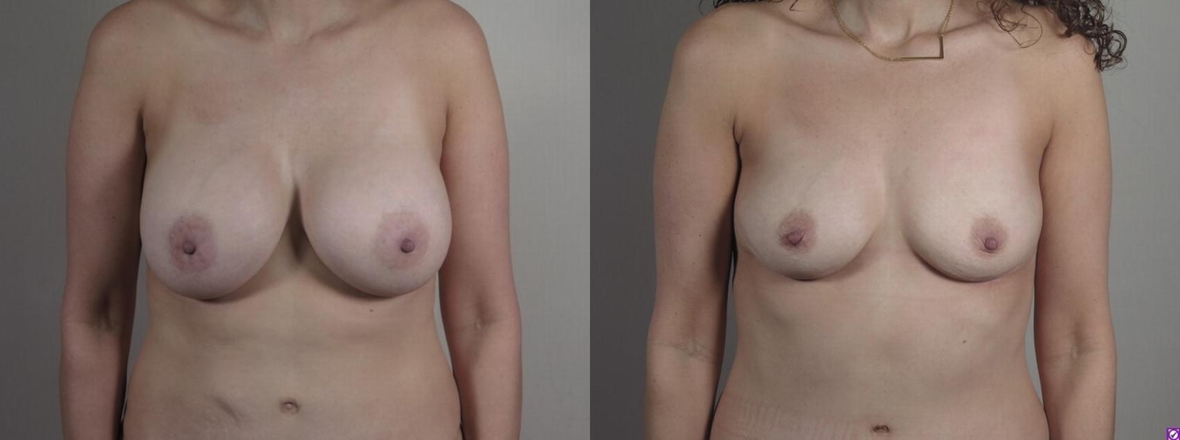 Breast Implant Removal Case 1237 Before & After Front | Paramus, New Jersey | Parker Center for Plastic Surgery