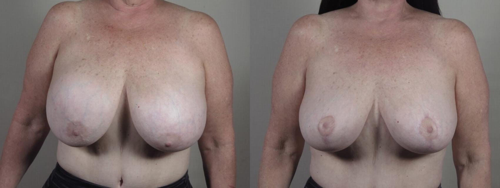 Breast Implant Removal Case 1239 Before & After Front | Paramus, New Jersey | Parker Center for Plastic Surgery