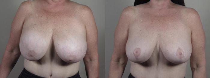 Breast Implant Removal Case 1239 Before & After Front | Paramus, New Jersey | Parker Center for Plastic Surgery